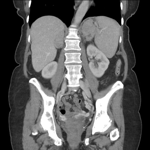 Bilateral adrenal granulocytic sarcomas (chloromas) (Radiopaedia 78375-91007 B 58).jpg