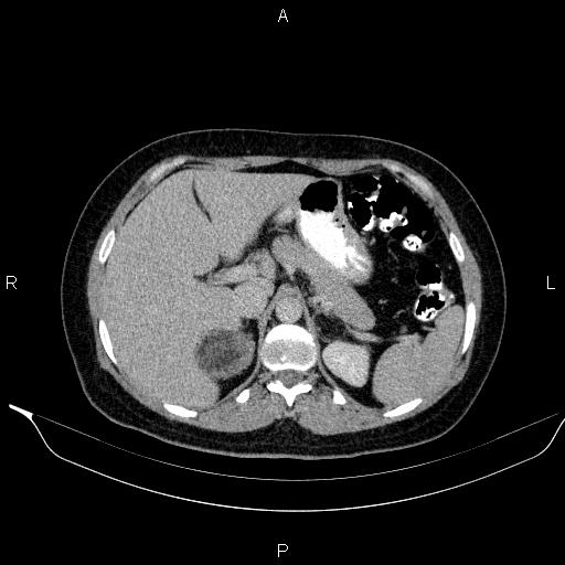 File:Bilateral adrenal myelolipoma (Radiopaedia 63058-71535 Axial C+ delayed 21).jpg