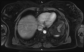 Bilateral adrenal myelolipoma (Radiopaedia 63058-71537 Axial T1 C+ fat sat 12).jpg