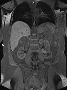 Bilateral adrenal myelolipoma (Radiopaedia 63058-71537 Coronal T1 fat sat 41).jpg