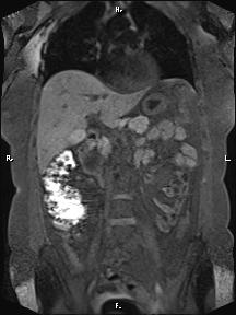 File:Bilateral adrenal myelolipoma (Radiopaedia 63058-71537 Coronal T1 fat sat 62).jpg