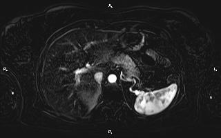 Bilateral adrenal myelolipoma (Radiopaedia 63058-71537 I 27).jpg