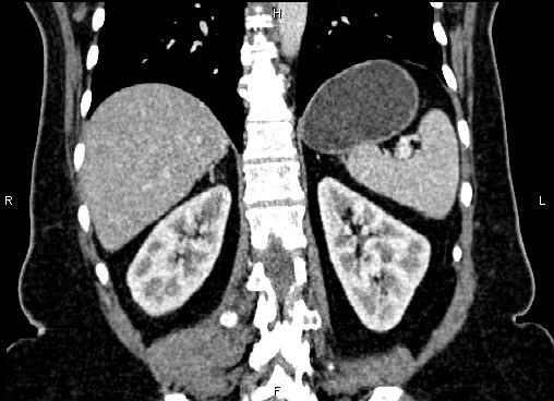 Bilateral benign adrenal adenomas (Radiopaedia 86912-103124 D 45).jpg
