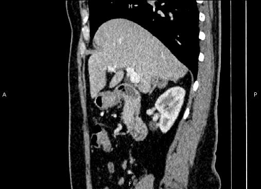 Bilateral benign adrenal adenomas (Radiopaedia 86912-103124 E 35).jpg