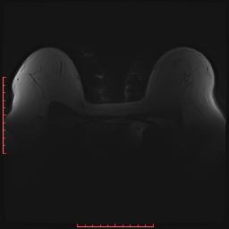 File:Bilateral breast implant rupture (Radiopaedia 24761-25027 PASTA Si 2).jpg