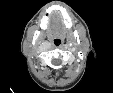 File:Bilateral carotid body tumors (Radiopaedia 61841-69870 Axial Post contrast 22).jpg