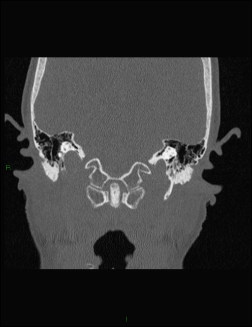 Bilateral frontal mucoceles (Radiopaedia 82352-96454 Coronal 322).jpg