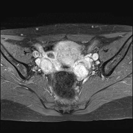 File:Bilateral ovarian endometriomas (Radiopaedia 87085-103347 Axial T1 C+ fat sat 9).jpg