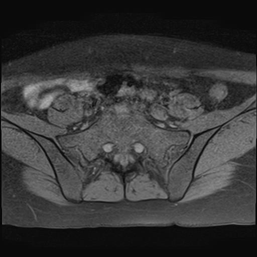 File:Bilateral ovarian endometriomas (Radiopaedia 87085-103347 Axial T1 fat sat 2).jpg