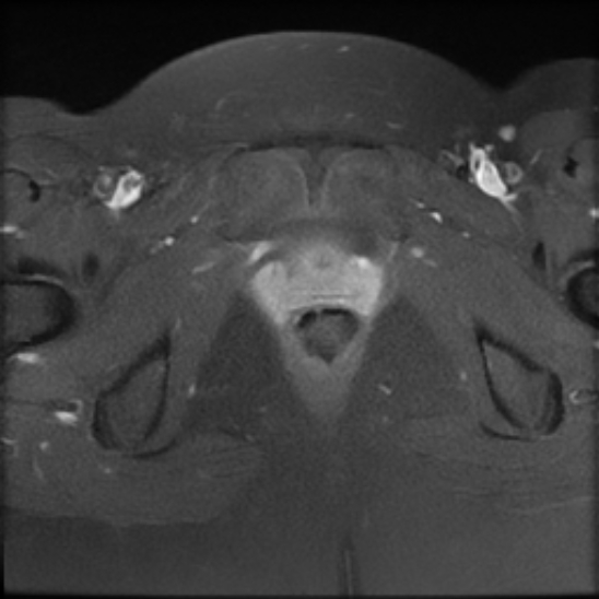 File:Bilateral ovarian fibrothecomas - adolescent (Radiopaedia 86604-102707 Axial T1 C+ fat sat 27).jpg