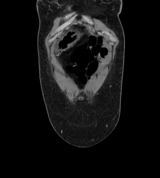 Bilateral ovarian mature cystic teratomas (Radiopaedia 79373-92457 B 3).jpg