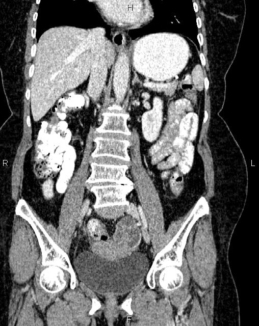 Bilateral ovarian serous cystadenocarcinoma (Radiopaedia 86062-101989 D 25).jpg