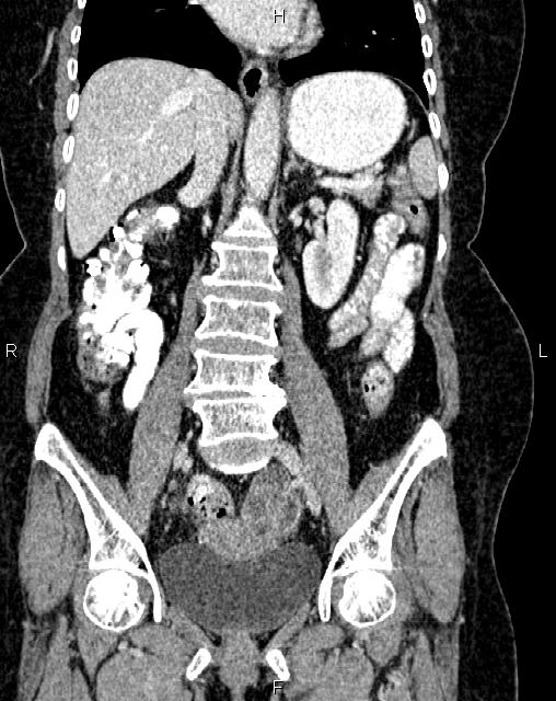Bilateral ovarian serous cystadenocarcinoma (Radiopaedia 86062-101989 D 26).jpg
