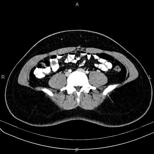 Bilateral ovarian teratoma (Radiopaedia 83131-97503 Axial With contrast 3).jpg