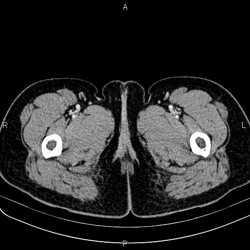 Bilateral ovarian teratoma (Radiopaedia 83131-97503 Axial With contrast 98).jpg