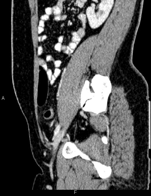 Bilateral ovarian teratoma (Radiopaedia 83131-97503 D 79).jpg