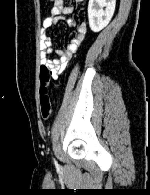 Bilateral ovarian teratoma (Radiopaedia 83131-97503 D 85).jpg