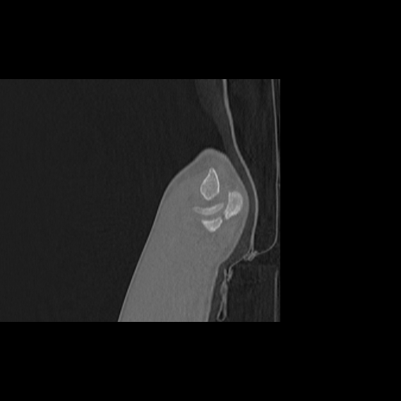 File:Bilateral proximal radioulnar synostosis (Radiopaedia 66532-75812 B 36).jpg