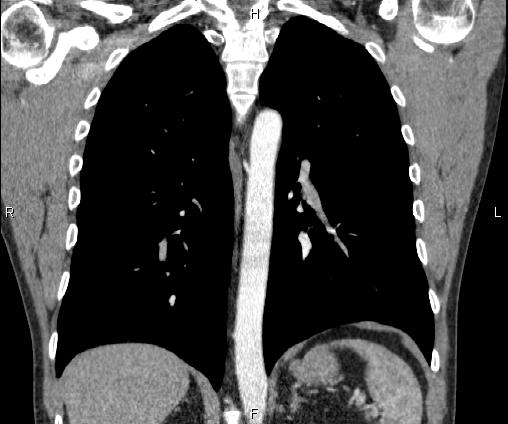 Bilateral pulmonary AVM (Radiopaedia 83134-97505 C 48).jpg
