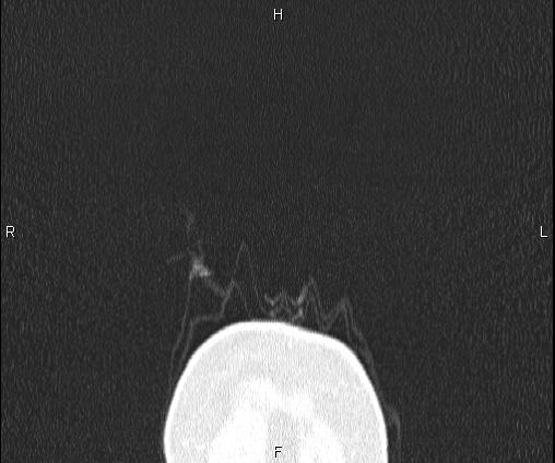 Bilateral pulmonary AVM (Radiopaedia 83134-97505 Coronal lung window 2).jpg
