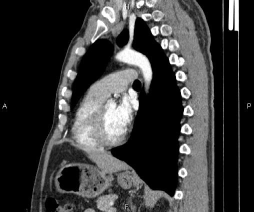 Bilateral pulmonary AVM (Radiopaedia 83134-97505 D 69).jpg