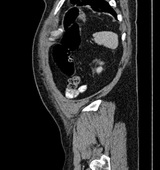 Bilateral rectus sheath hematomas (Radiopaedia 50778-56252 B 69).jpg