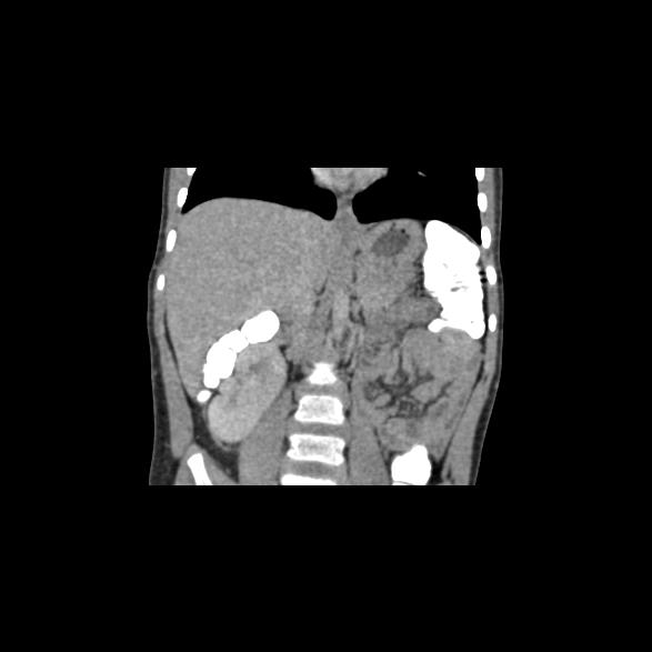 File:Bilateral renal malrotation (Radiopaedia 30901-31606 B 20).jpg