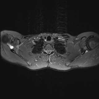 File:Bilateral spinoglenoid notch ganglion cysts (Radiopaedia 29577-30082 Axial STIR 16).jpg