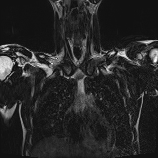 Bilateral spinoglenoid notch ganglion cysts (Radiopaedia 29577-30082 Coronal T2 37).jpg