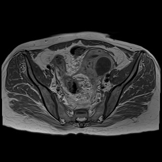 Bilateral tubo-ovarian abscesses (Radiopaedia 58635-65829 Axial T1 C+ 19).jpg