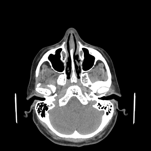 File:Bisphosphonate-related osteonecrosis of the jaw (Radiopaedia 71324-81642 non-contrast 151).jpg