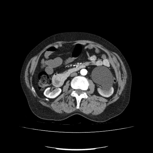 File:Bladder tumor detected on trauma CT (Radiopaedia 51809-57609 A 115).jpg
