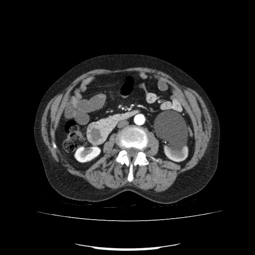 File:Bladder tumor detected on trauma CT (Radiopaedia 51809-57609 A 117).jpg