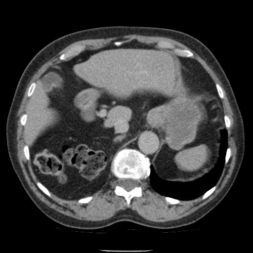 Bladder tumor detected on trauma CT (Radiopaedia 51809-57609 C 34).jpg