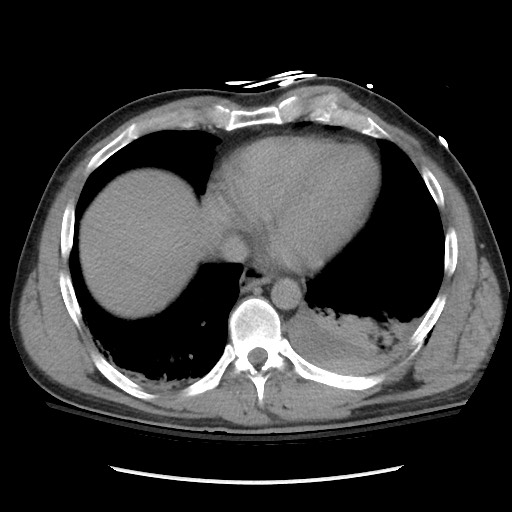Blunt abdominal trauma with solid organ and musculoskelatal injury with active extravasation (Radiopaedia 68364-77895 Axial C+ delayed 13).jpg