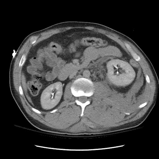 File:Blunt abdominal trauma with solid organ and musculoskelatal injury with active extravasation (Radiopaedia 68364-77895 Axial C+ delayed 59).jpg