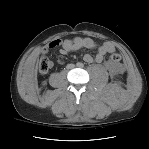 Blunt abdominal trauma with solid organ and musculoskelatal injury with active extravasation (Radiopaedia 68364-77895 Axial C+ delayed 81).jpg