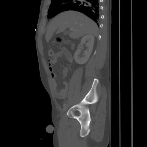 Blunt abdominal trauma with solid organ and musculoskelatal injury with active extravasation (Radiopaedia 68364-77895 Sagittal bone window 28).jpg