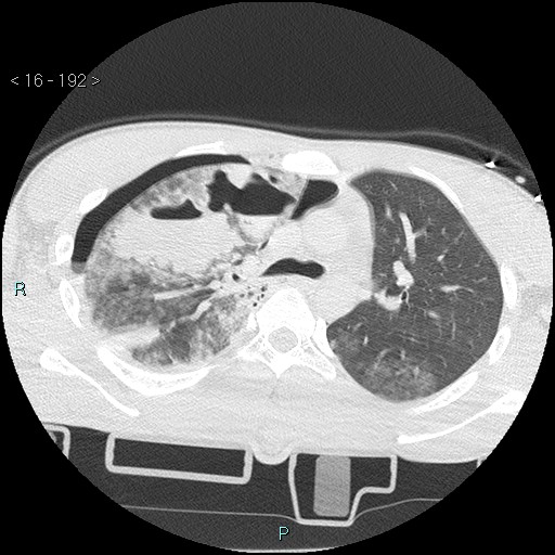 Blunt chest trauma (Swiss cheese sign) (Radiopaedia 38519-40618 Axial lung window 24).jpg
