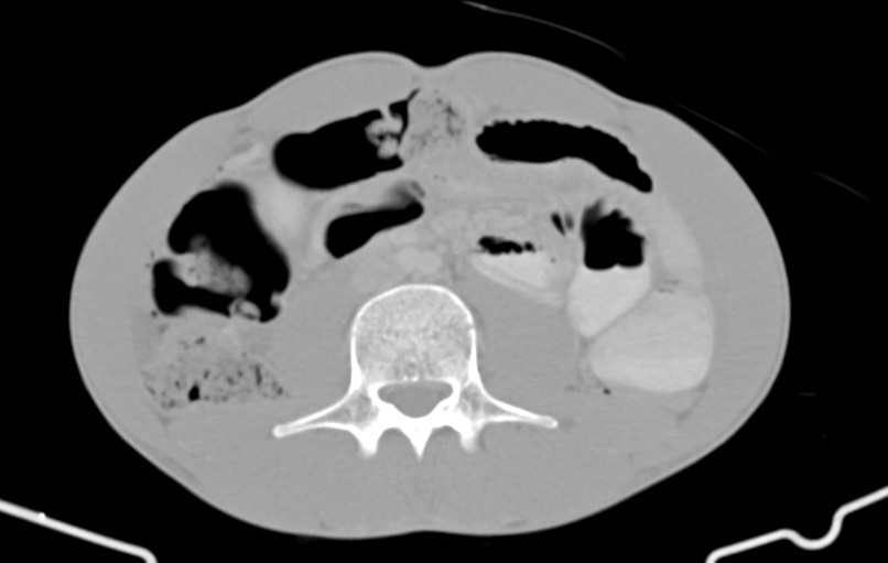 Blunt injury to the small bowel (Radiopaedia 74953-85987 Axial Wide 50).jpg
