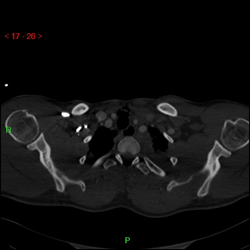 Blunt thoracic trauma (Radiopaedia 73454-84221 Axial bone window 11).jpg
