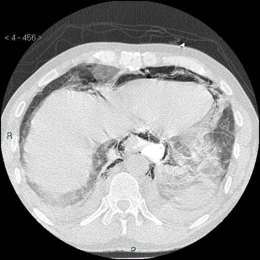 Boerhaave syndrome (Radiopaedia 27683-27897 lung window 88).jpg