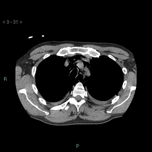 Boerhaave syndrome (Radiopaedia 27683-27897 oral contrast 31).jpg