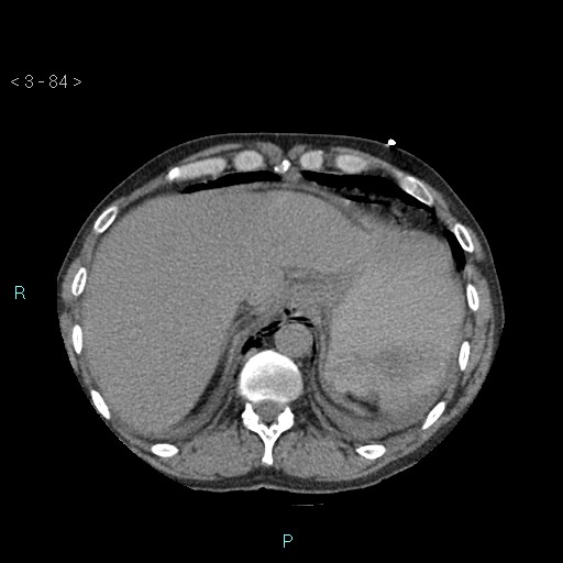 Boerhaave syndrome (Radiopaedia 27683-27897 oral contrast 84).jpg