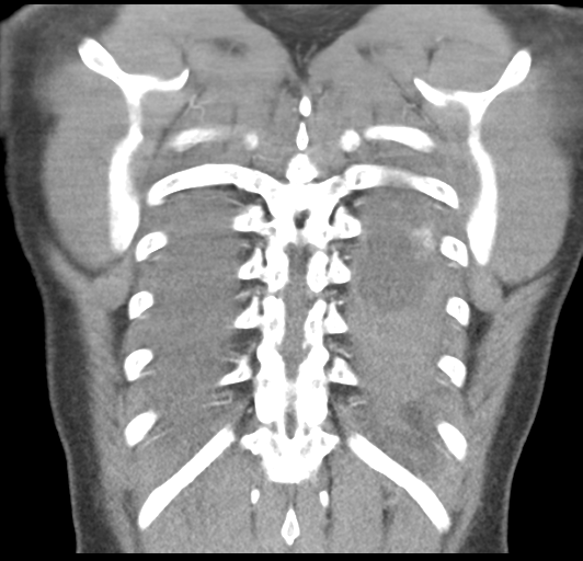 Boerhaave syndrome (Radiopaedia 39382-41661 B 48).png