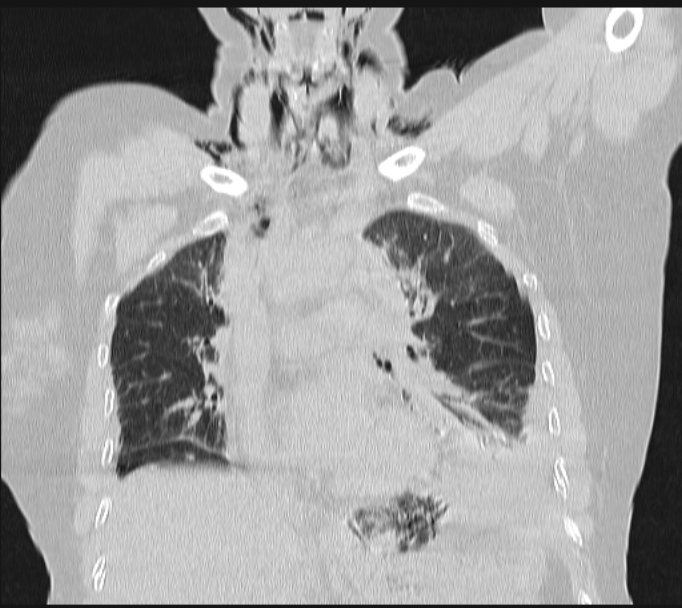 Boerhaave syndrome (Radiopaedia 45644-49799 Coronal lung window 30).jpg