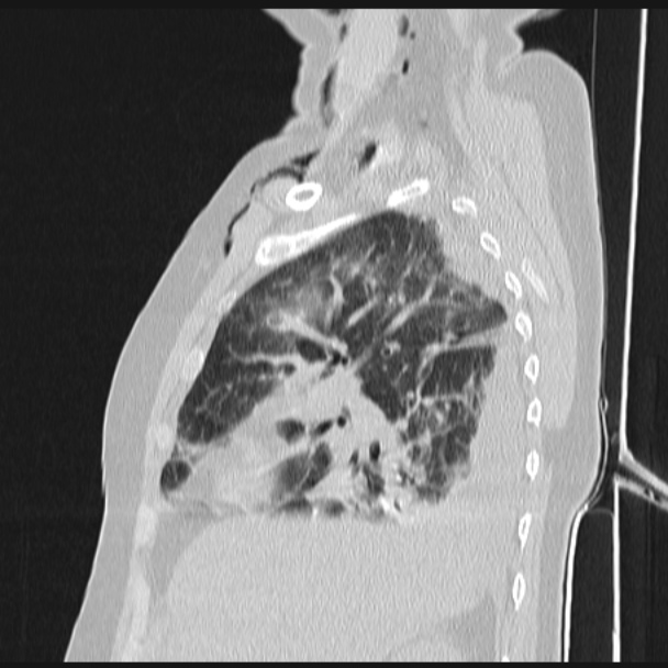 Boerhaave syndrome (Radiopaedia 45644-49799 Sagittal lung window 24).jpg