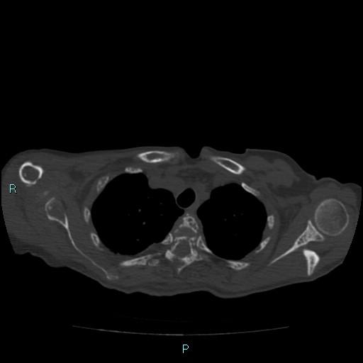 Bone metastases from untreated breast cancer (Radiopaedia 42973-46219 Axial bone window 22).jpg