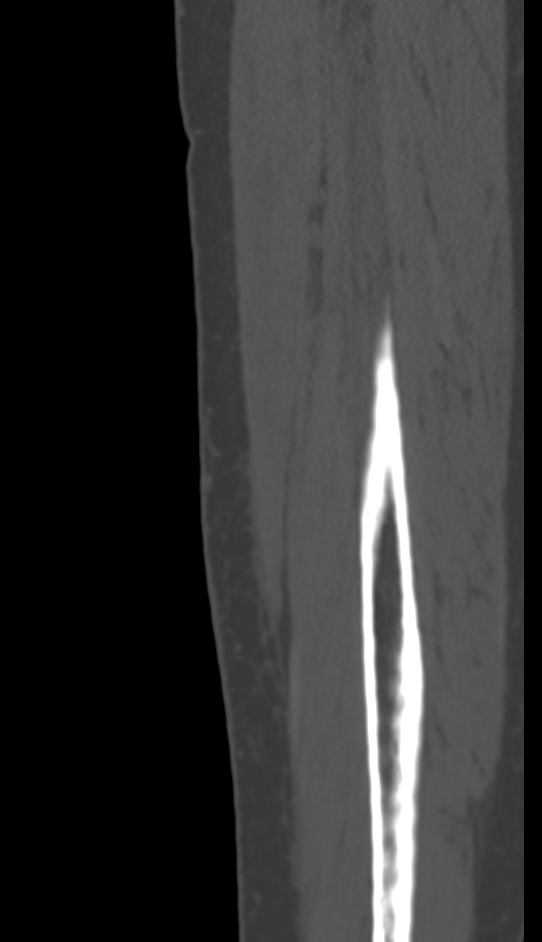 Bone metastasis - tibia (Radiopaedia 57665-64609 Sagittal bone window 159).jpg