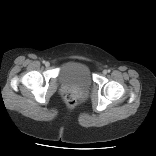 File:Borderline mucinous tumor (ovary) (Radiopaedia 78228-90808 A 136).jpg